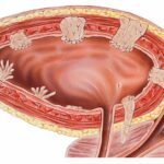 Novel Urine Test for Bladder Cancer Developed