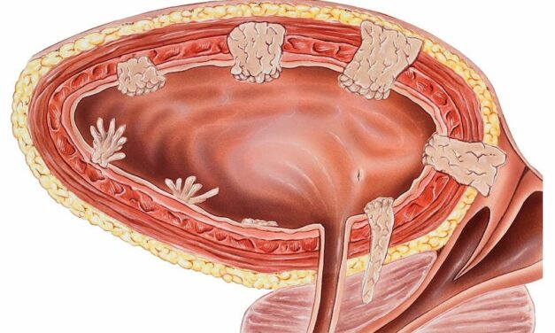 Novel Urine Test for Bladder Cancer Developed