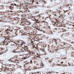 FDA Approves VENTANA PD-L1 as a CDx for NSCLC Subtype