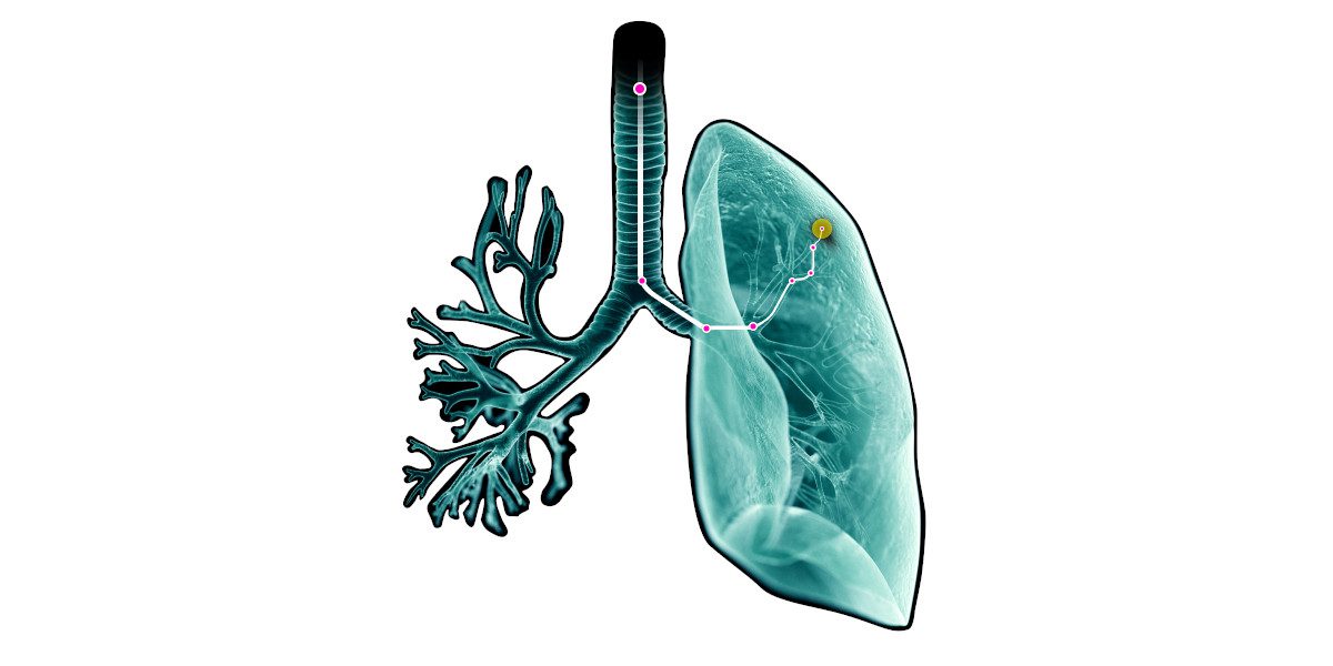 Steerable Needle, CT Imaging Enable Definitive Diagnosis of Lung Nodule