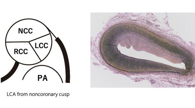 Molecular Autopsy Helps Explain Death of Child with COVID-19