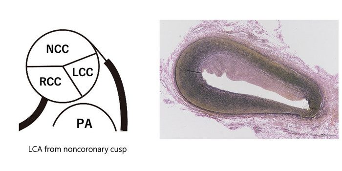 Molecular Autopsy Helps Explain Death of Child with COVID-19