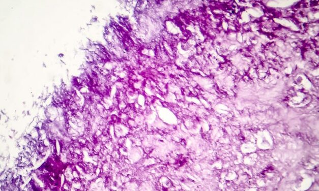 CXCL 13 Protein Is Potential Biomarker Measuring Immunotherapy Response