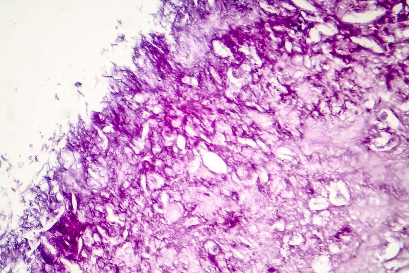 CXCL 13 Protein Is Potential Biomarker Measuring Immunotherapy Response