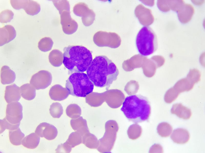 New Assay Could Revolutionize Acute Myeloid Leukemia Detection