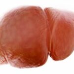 Diagnosing and Managing Steatotic Liver Disease