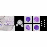 New AI-Based Method Supports Acute Myeloid Leukemia Diagnosis