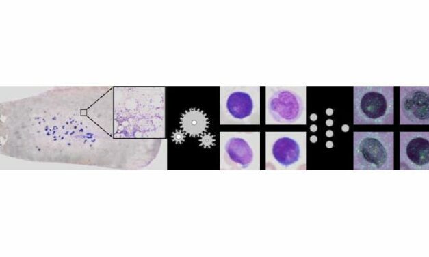 New AI-Based Method Supports Acute Myeloid Leukemia Diagnosis