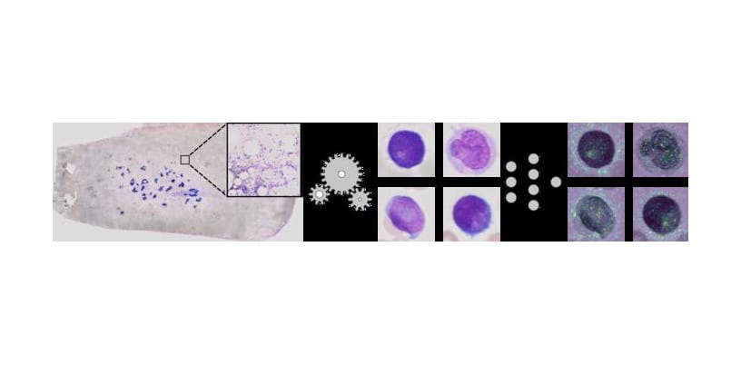 New AI-Based Method Supports Acute Myeloid Leukemia Diagnosis