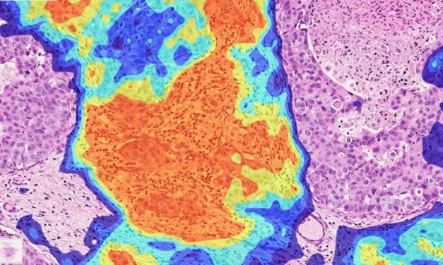 Ibex Showcases Diagnostic Efficiency of AI in Prostate, Breast, and Gastric Cancer