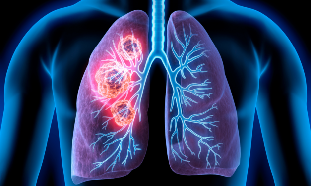 Qlucore Insights Can Classify Primary Lung Samples, Metastatic Lesions
