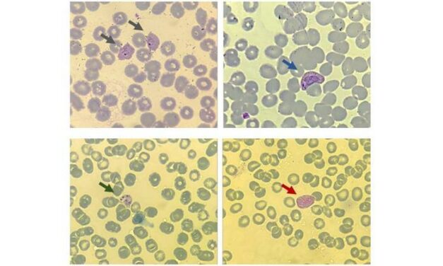 P. Vivax Malaria Biomarkers Associated with Recurrence Identified