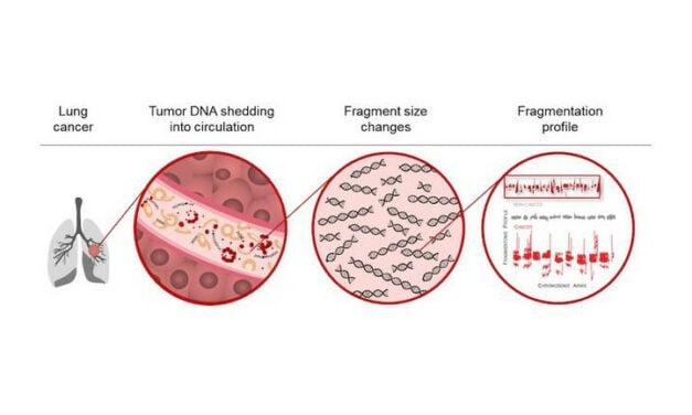AI Blood Test Reliably Identifies Lung Cancer