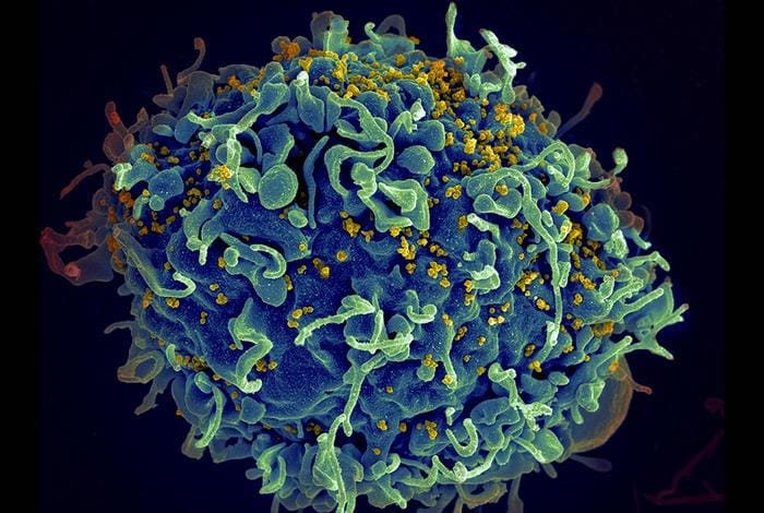 Lab Test May Lead to Direction of HIV Cure