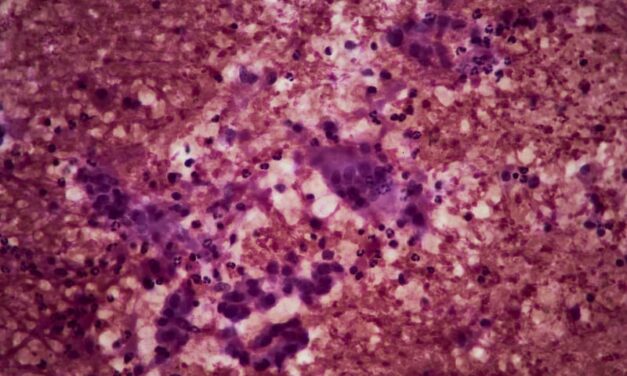 Pancreatic Cystic Neoplasm
