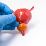 Prostate Cancer: Is AI the Answer to Limit Need of Biopsies?