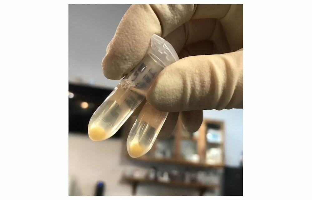 New Blood Test for ALS Offers 98% Accuracy and Faster Diagnoses