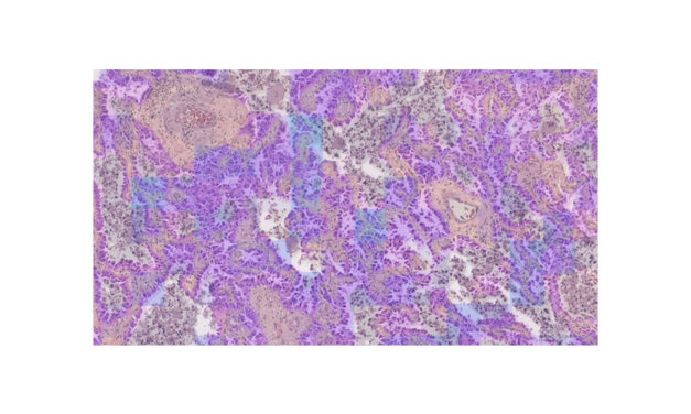 PathAI Adds MET Predict to AISight for NSCLC Assessments