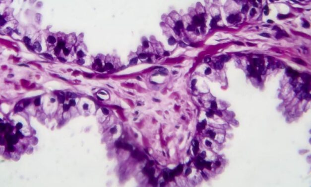 How Prostate Cancer Screening Advancements Are Reducing Overtreatment