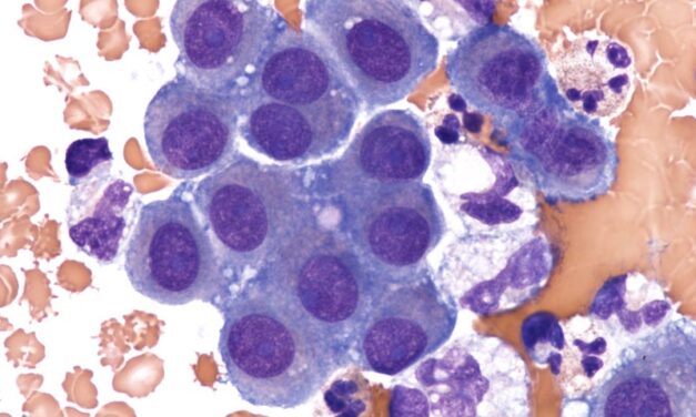 Mesothelioma Cancer Detection May Improve with New Test