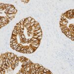 FDA Approves Roche’s HER2 Companion Diagnostic for Biliary Tract Cancer Treatment