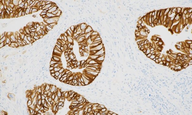 FDA Approves Roche’s HER2 Companion Diagnostic for Biliary Tract Cancer Treatment