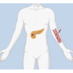 How Liquid Biopsy is a Promising Tool to Detect Pancreatic Cancer Early