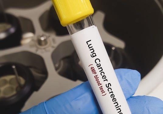 Lung Cancer Test Differentiates Malignant and Benign Nodules