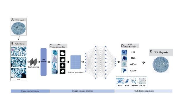 How AI is Revolutionizing Cervical Cancer Screening