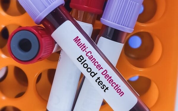Galleri MCED Test Available via Quest’s Ordering System