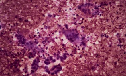 Pancreatic Cancer Test Wins Approval from NYS Department of Health