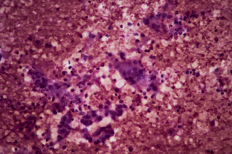 Pancreatic Cancer Test Wins Approval from NYS Department of Health