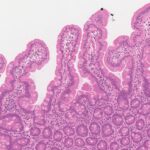 Celiac Disease: AI Could Be Tool to Aid, Speed Diagnosis