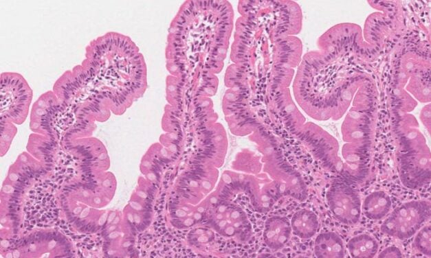 Celiac Disease: AI Could Be Tool to Aid, Speed Diagnosis