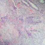 Crohn’s Disease with Joint Inflammation Biomarker ID’d