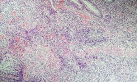 Crohn’s Disease with Joint Inflammation Biomarker ID’d