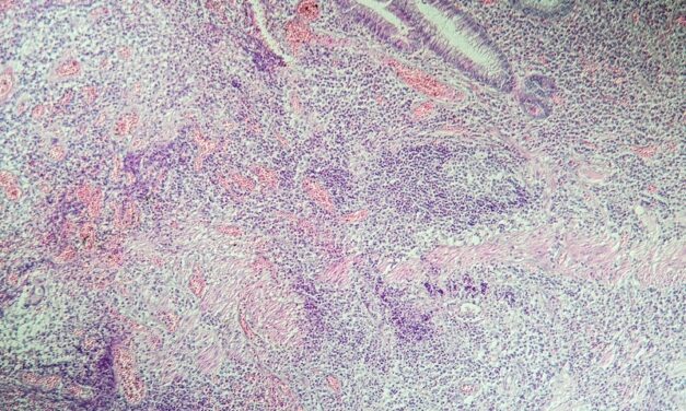 Crohn’s Disease with Joint Inflammation Biomarker ID’d
