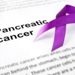 KRAS ctDNA Is Predictor of Metastasis and Survival in Pancreatic Cancer