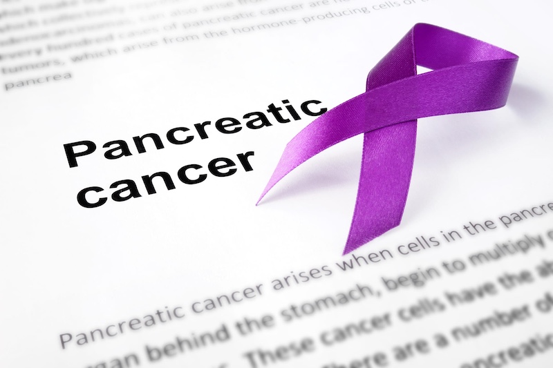 KRAS ctDNA Is Predictor of Metastasis and Survival in Pancreatic Cancer