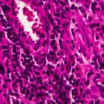 Muscle-Invasive Bladder Cancer Data Demonstrates Accuracy of Whole-Genome Sequencing-Based MRD Testing Platform