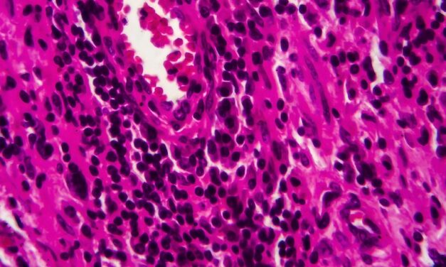 Muscle-Invasive Bladder Cancer Data Demonstrates Accuracy of Whole-Genome Sequencing-Based MRD Testing Platform