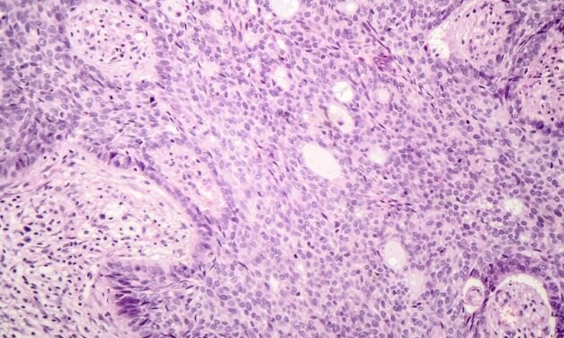 Skin Cancer