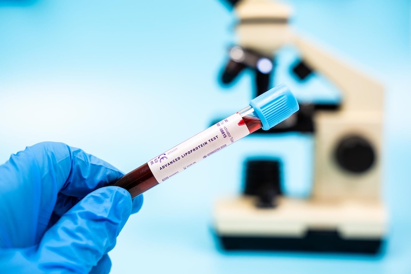 Heart Disease Risk Could Be Predicted with a Simple Test