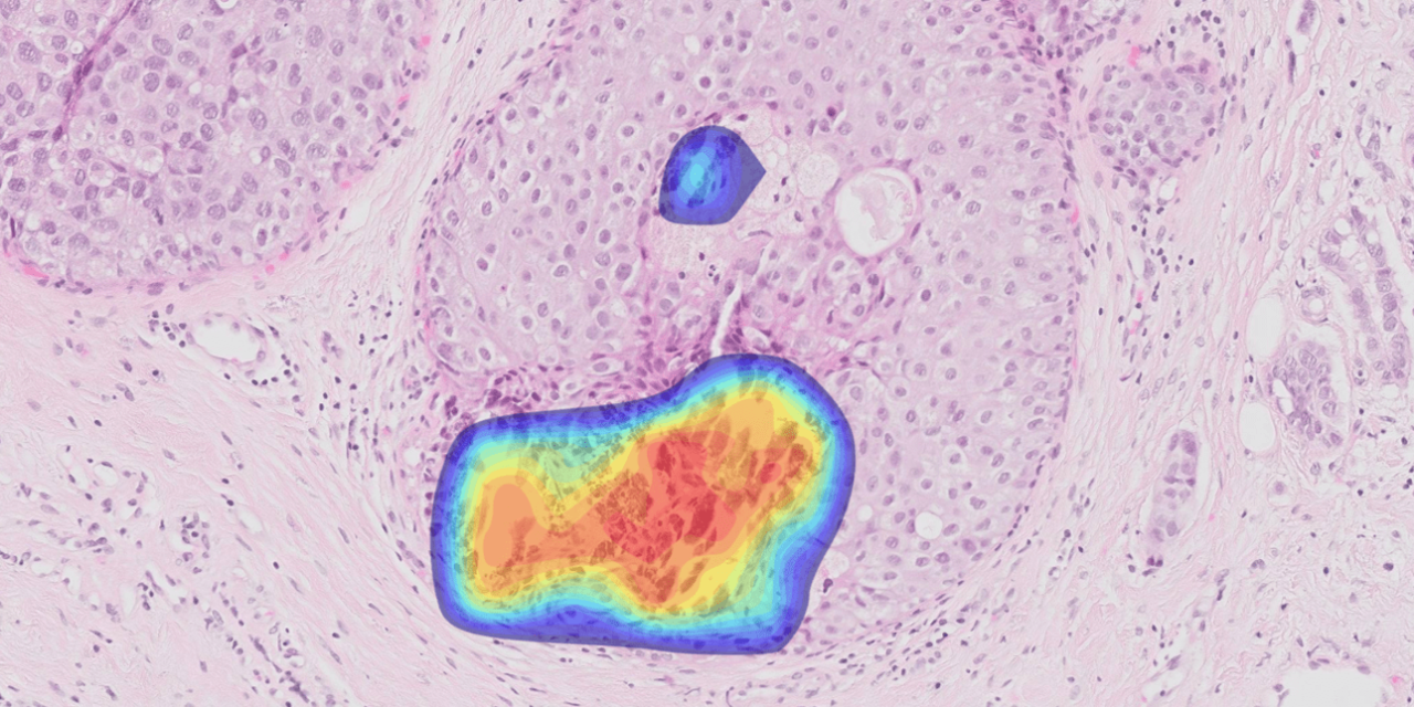 Ibex Breast Demonstrates High Accuracy, Efficiency in Study