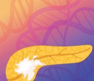 AI Blood Test Could Be Key to Measure Pancreatic Cancer Therapy Success