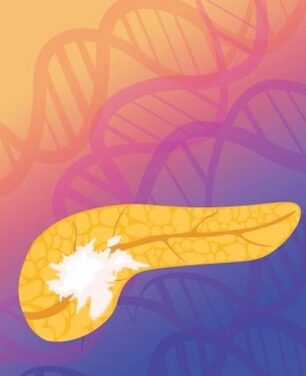 AI Blood Test Could Be Key to Measure Pancreatic Cancer Therapy Success