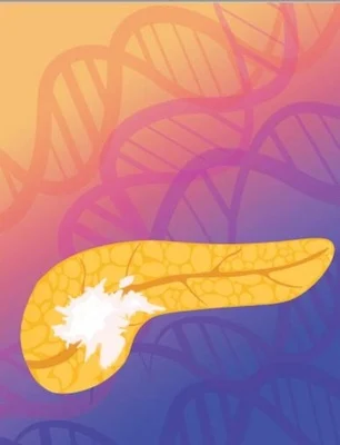 AI Blood Test Could Be Key to Measure Pancreatic Cancer Therapy Success