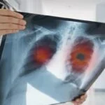 mNGS Test Detects Three Times More Lung Pathogens Than Traditional Methods