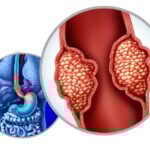 Esophageal Precancer Testing Program Launched at Hoag