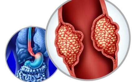 Esophageal Precancer Testing Program Launched at Hoag